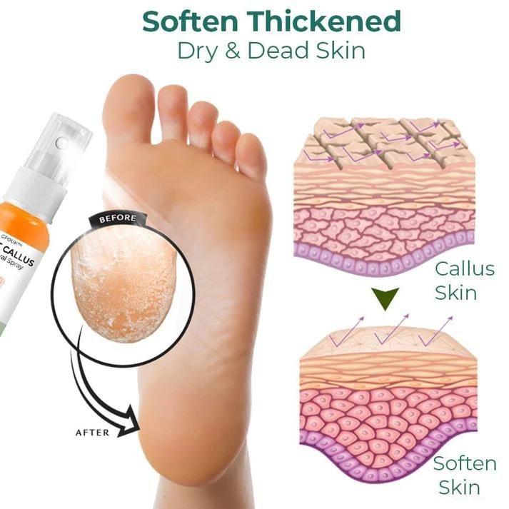 Foot Callus Removal Spray – Dead Skin Remover & Smooth Heel Care Spray
