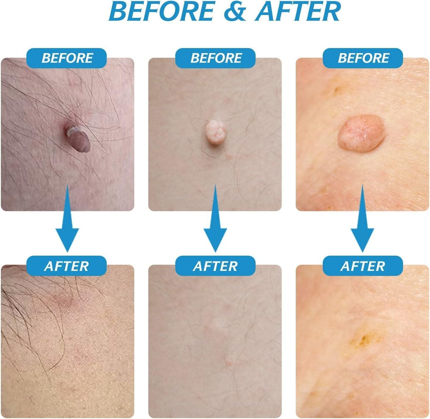 2-in-1 Skin Tag Remover Kit – Painless & Safe Skin Care Tool